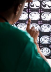 Enfermedades autoinmunes en neurología